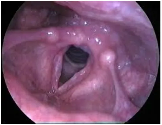 Fig:5 Contact ulcer
