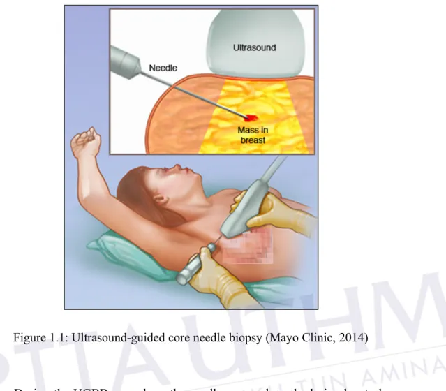 Figure 1.1: Ultrasound-guided core needle biopsy (Mayo Clinic, 2014) 