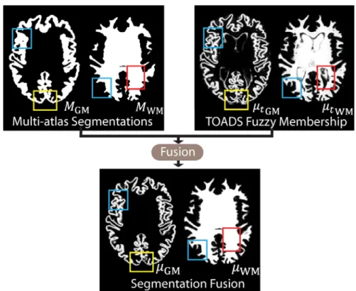 Figure  III.4  Refined  segmentations  are  obtained  from  segmentation  fusion  with  the  following characteristics: (1) PVE issues in NLSS multi-atlas segmentation are resolved  (blue  rectangles),  (2)  the  fused  segmentations  have  WM  labels  con