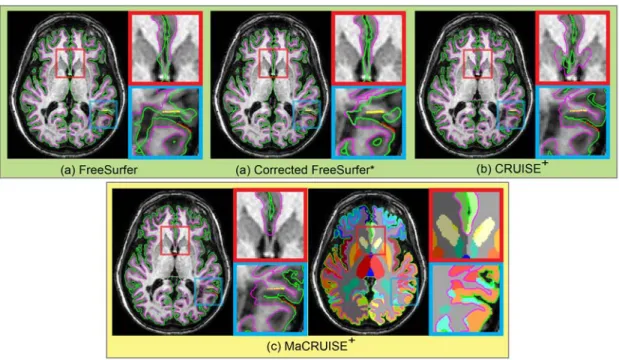 Figure III.8 Inner and outer surfaces are shown for each method for an MS subject. Red and  yellow  dots  in  blue  and  red  rectangles  are  the  manual  outer  and  inner  surface  landmarks,  respectively, near WM lesions