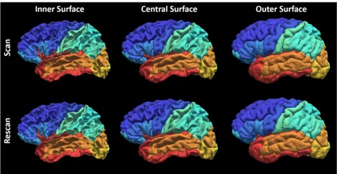 Figure  IV.3 Qualitative  reproducibility results on  the  surface  parcellation  between  a  randomly  selected scan-rescan patient using MaCRUISEsp