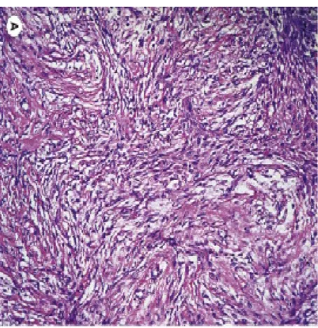 Figure 11- Microscopic Appearance Of Metaplastic Carcinoma 