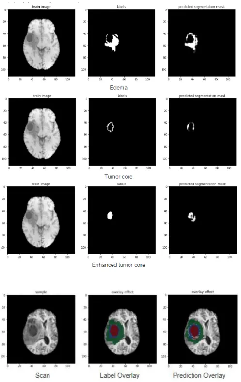 Figure 10: Prediction result of VAE model. The first three rows show segmentation truth and prediction  for each part of the tumor and the last row shows an overlay of them on a real scan
