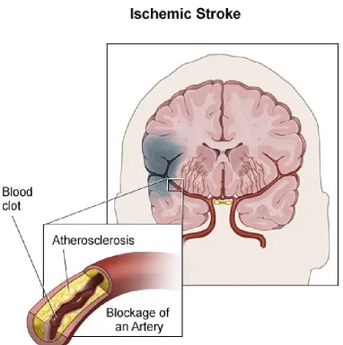 Figure 1 Atherosclerosis and acute ischemic stroke 