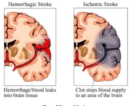 Figure 2 Types of Stroke 