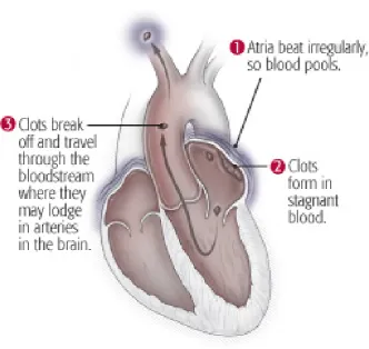 Figure 9  Embolic Stroke in Atrial  Fibrillation 