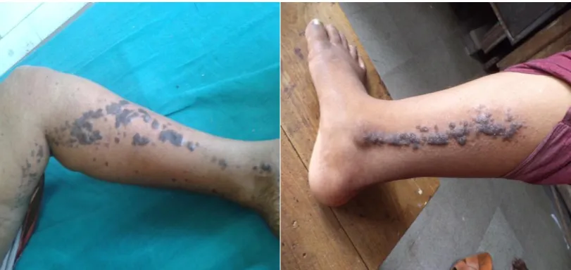 FIG 3.LINEAR LICHEN PLANUS IN LOWERLIMB IN TWO PATIENTS