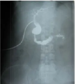 Figure 23  10th day T-tube cholangiogram with free flow of bile into tube cholangiogram with free flow of bile into tube cholangiogram with free flow of bile into 