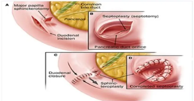 Figure 12 Endoscopic sphincterotomyFigure 12 Endoscopic sphincterotomy