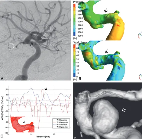 Fig 2. Ademonstrate increased forces at the site of future aneurysm., Right ICA lateral view DSA of patient 2 shows no aneurysm at the upper wall of the C2 ICA segment (arrow)