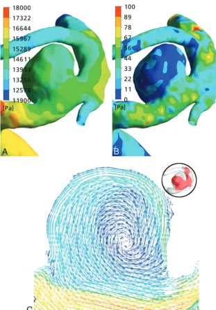 Fig 3. A and B, Surface pressure (A) and WSS (B) distribution maps of the aneurysm of patient 2
