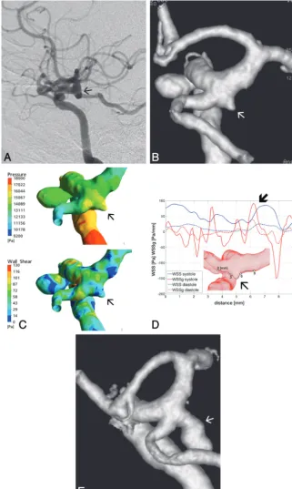Fig 4. A(6 and 7 respectively (by the 3D reconstruction angiogram ( and B, Lateral view DSA of the right ICA of patient 3 shows an aneurysm at the carotid cave; however, no aneurysm beginning is visible at the origin of the PcomA (A), demonstratedarrows, B