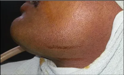 Fig.4-Skin Incision 