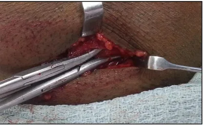 Fig.5-Layer wise Dissection 