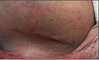 Fig.11-Layer wise Closure 