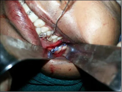 Fig.13-Exposure of the Fracture Segment 
