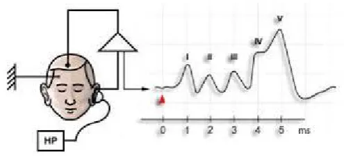FIGURE 9 : Recording of BAEP waveforms 