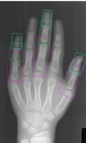 Figure 3.2: A hand X-ray with the eight bones boxed: proximal (purple, bottom), middle (green, middle), and distal (blue, top) phalanges