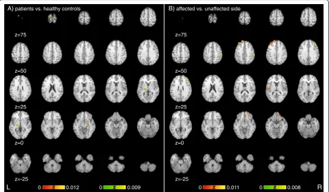 Fig. 2 Significant areas of experiments showing differences between a) patients and healthy controls as well as differences between theb) affected versus the unaffected side sorted along the Y-axis of the Talairach space representing the dorsoventral-axis