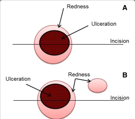 Figure 5 Incision erythema and ulceration differentiation.outer ring would be included in the erythema score