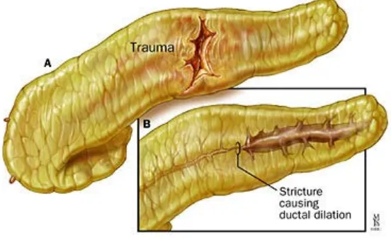 Figure 9. A, B, Pancreatic injury from trauma. 