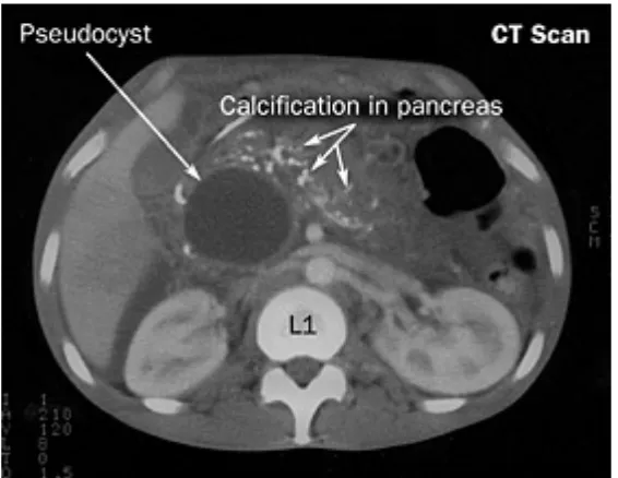 Figure 12. CT scan demonstrating chronic pancreatitis. 