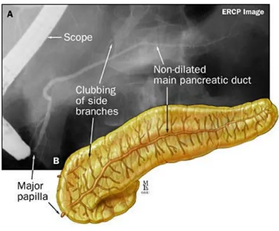 Figure 18. A, B, ERCP demonstrating mild chronic pancreatitis. 