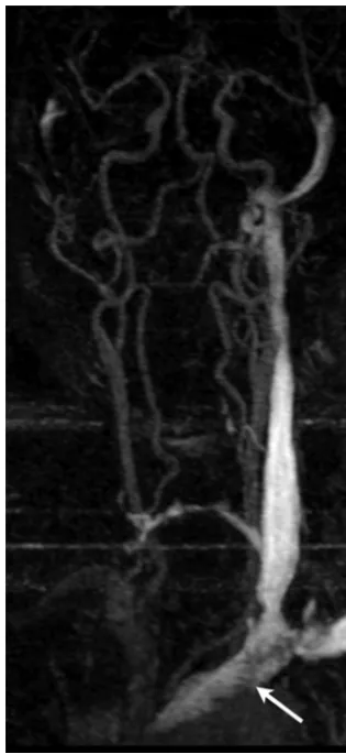 Fig 4. MRA MIP of a patient with reflux shows poststenotic dilation (white arrow).