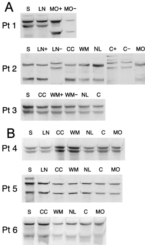 FIG. 3. (A) Analysis by SSCP of 5�from serum (S) and various autopsy brain tissue samples from patients1 to 3 (Pt 1 to Pt 3)