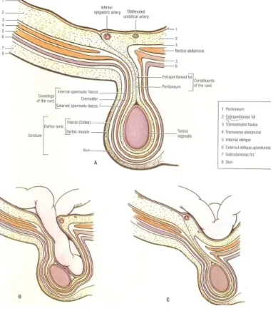 Figure-16. Coverings of inguinal hernia (A), Indirect (B), and Direct (C) 