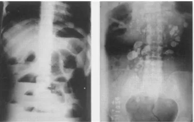 Figure1(a):AbdomenX-ray(erectfilm)