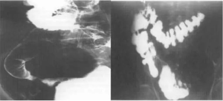 Figure 2(a): Barium meal follow through showing distal ileal stricture. (b):Bariumenema showing terminal ileal stricture with proximal dilatation.
