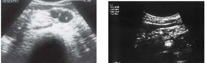 Figure:3 (a) Abdominal ultrasonography showing enlarged mesentericlymph