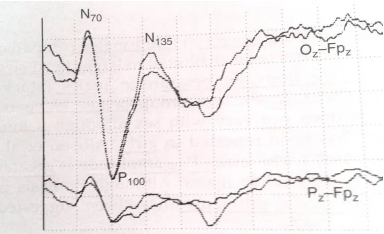 Fig 5     Normal VEP Waveform 
