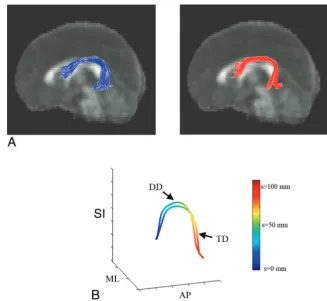 Fig 2. Preparation of TBM analysis. A, Input multisubject fiber bundles of the AF: left TD (blue) and right DD (red)