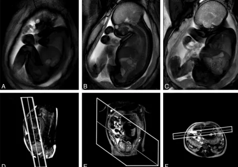 Fig 1. Example of a cine acquisition at GA 36 weeks. A–C, Successive frames from a multisection cine image sequence (section thickness, 30 mm)
