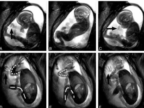 Fig 2. Examples of the fetal movement repertoire.older fetus also shows GM consisting of flexion at the knee joint (dashed line) as well as at the elbow (overall variability in amplitude of movements that older fetuses perform is significantly reduced and 