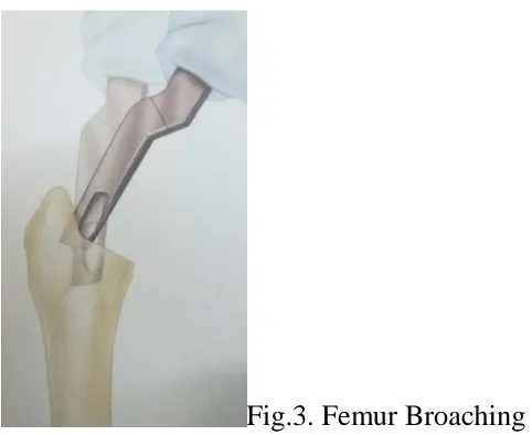 Fig.3. Femur Broaching 