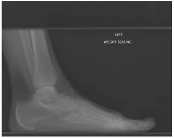 Figure 3 : Lateral Foot X-ray (Original) 