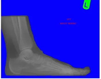Figure 5 : Planar Foot X-Ray (Original) 