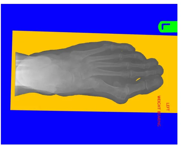 Figure 6 : Planar Foot X-Ray with Unwanted Elements Highlighted 