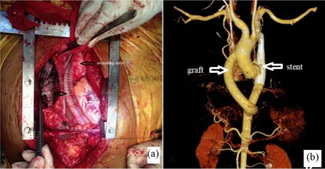 Figure 1. (a) CTA showing CoA before stenting; (b) CTA image after stenting.  