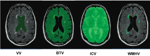Fig 1. Manual segmentation of brain volumes.