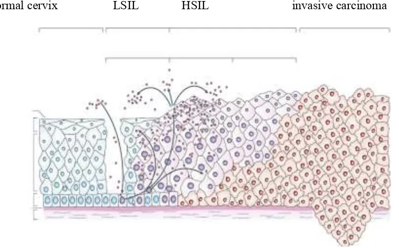 Fig : 5 Evolution of CIN(SIL) and invasive carcinoma from normal cervix 