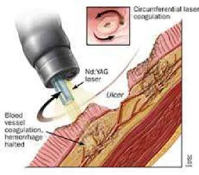 Fig.10 LASER 