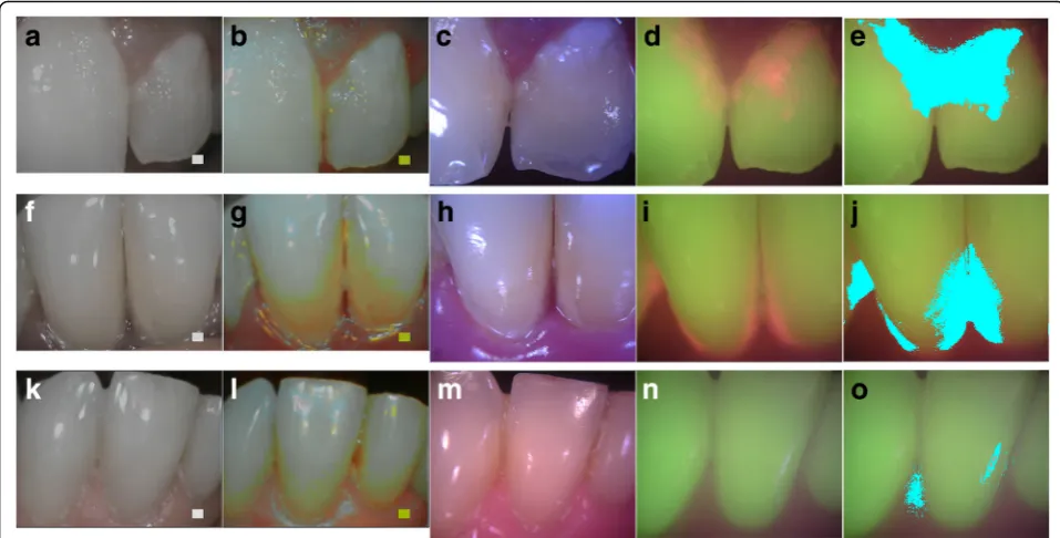 Fig. 4 Comparison images captured by reference device and Plaquefinder. Columns from left to right: reference device white light; referencedevice plaque mode; Plaquefinder white light; Plaquefinder 405 nm light, segmented Plaquefinder 405 nm light images