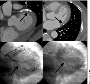 Fig. 4. Stent patency evaluationby MDCT. The stent patencyevaluation was possible by adensitymeasurementandadirect visual assessment in thelumen of the stent.