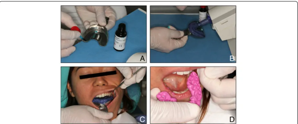 Figure 1 Conventional impression technique. Conventional impression technique. A) Adhesive application, B) Impression tray loading,C) Upper and lower arches impression, D) Bite registration.
