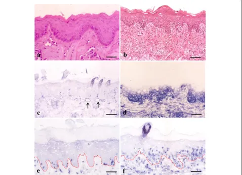 Figure 1 Immunohistochemical expression of intercellular adhesion molecule-1 (ICAM-1) and CD8+ in graft-versus-host disease(GVHD)-related oral mucosa