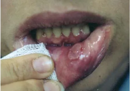 Fig.3 : Oral Ulceration seen in patient with Behçet’s Disease